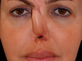 Ex of former Arsenal star Arshavin shows bad results of transformation of nose