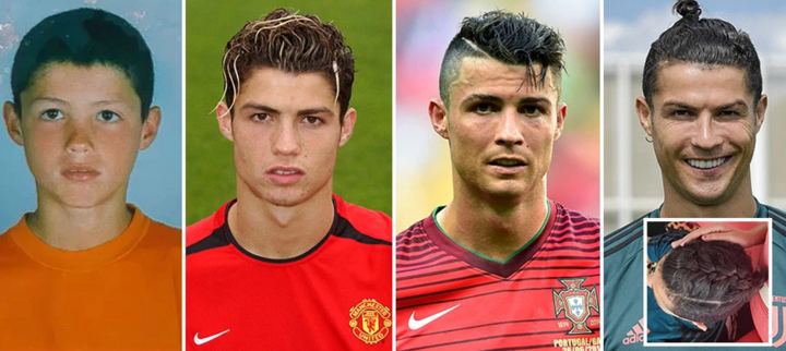 Cristiano Ronaldo Hair Transplant: The Iconic Transformation